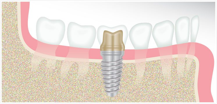 diagram of dental implants